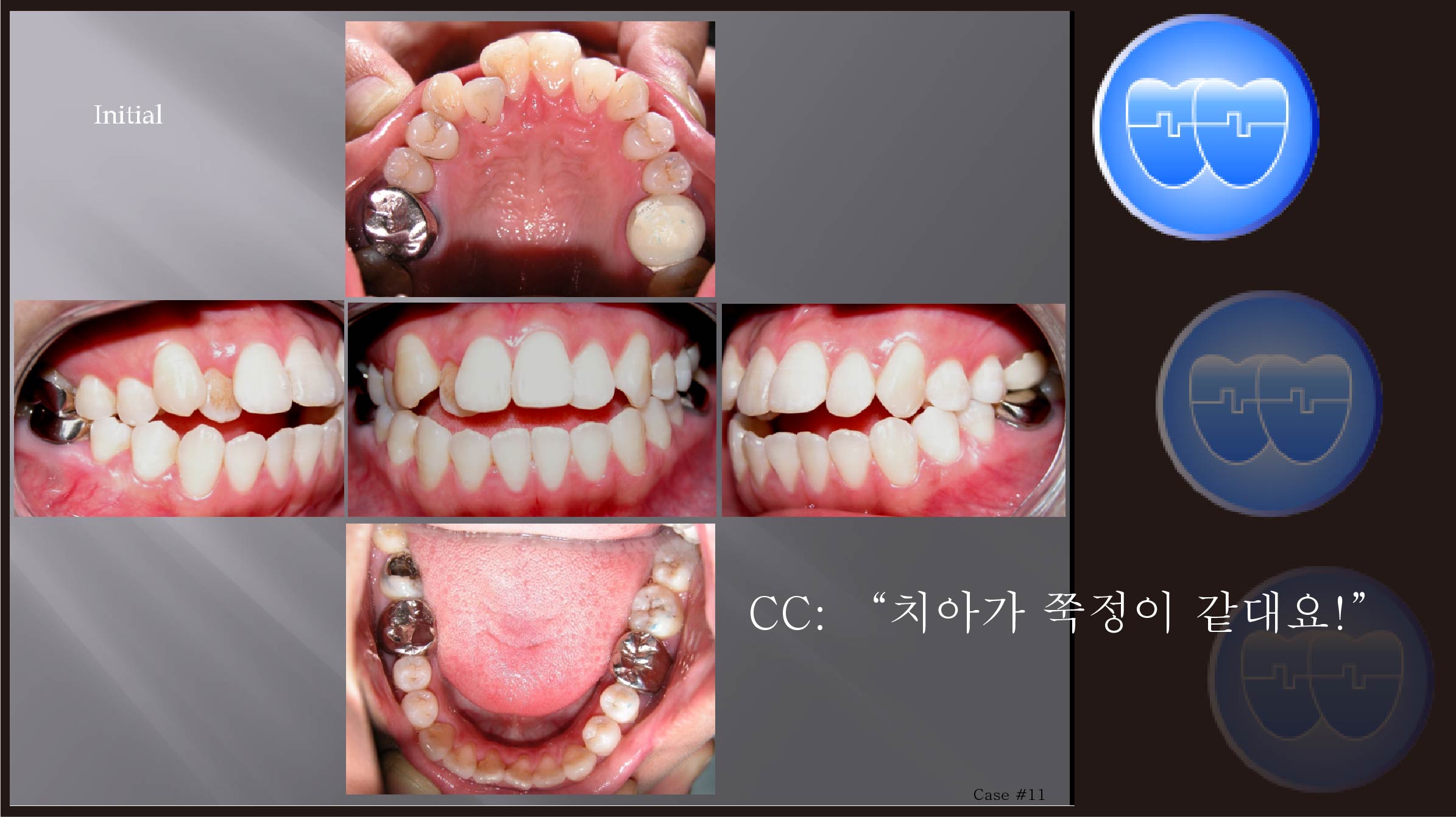 교정 Case 11.  U6L6 발치, Molar Substitution, Dental Openbite, Sem #7