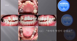 교정 Case 11.  U6L6 발치, Molar Substitution, Dental Openbite, Sem #7