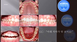 교정 Case 15.  비발치, 100% Dental Deepbite, Lower Incisor Bracket Interference, Sem #3