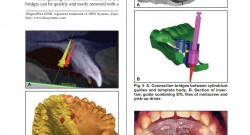 Palatal Miniscrew를 심을 때의 3차원적 고려