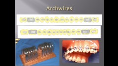 (실습 4) Bracket DBS, Archwire Placement, Tie-in 실습