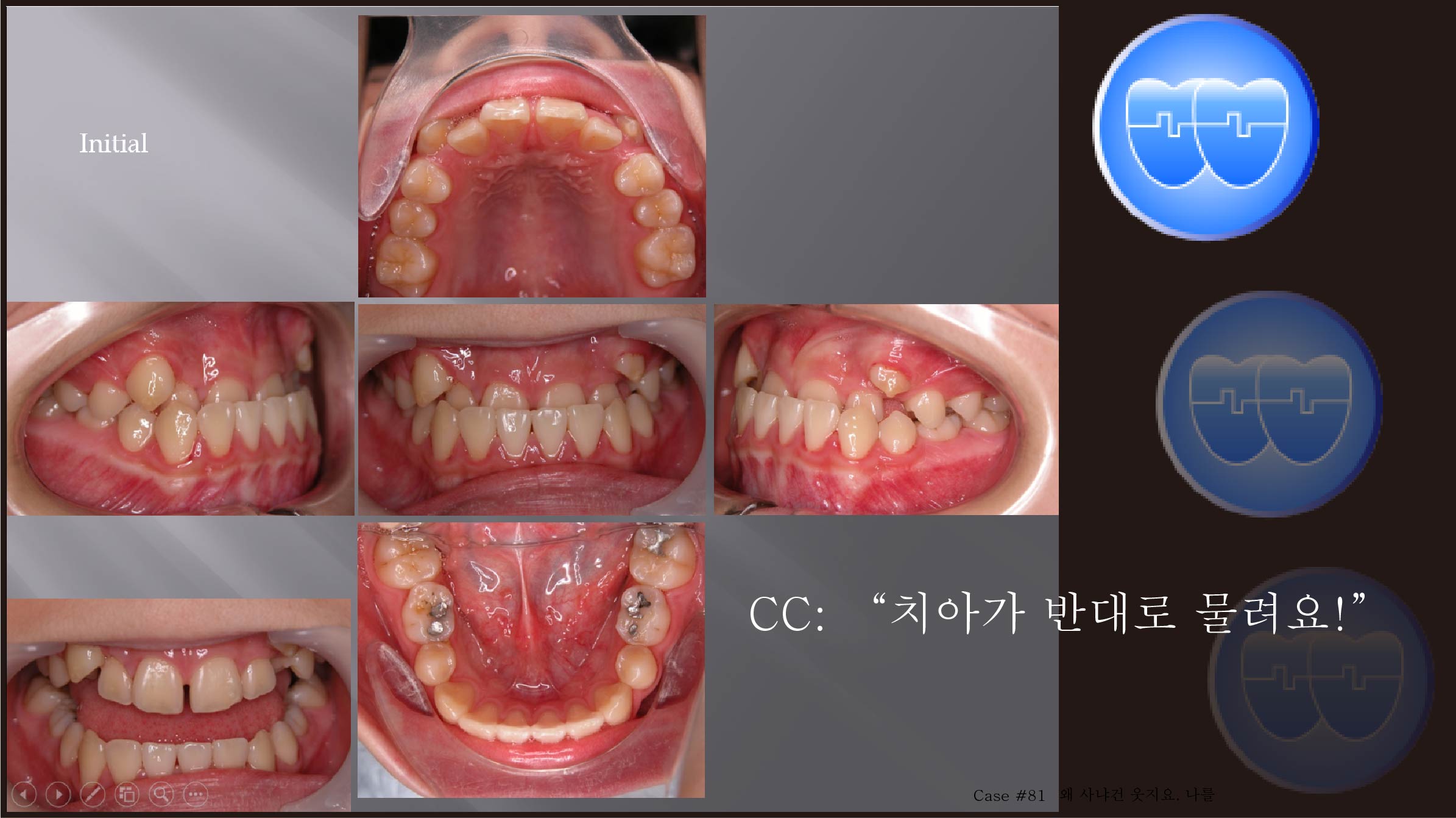 교정 Case 81.  비발치, Class III, Deep Underbite, Sem #5