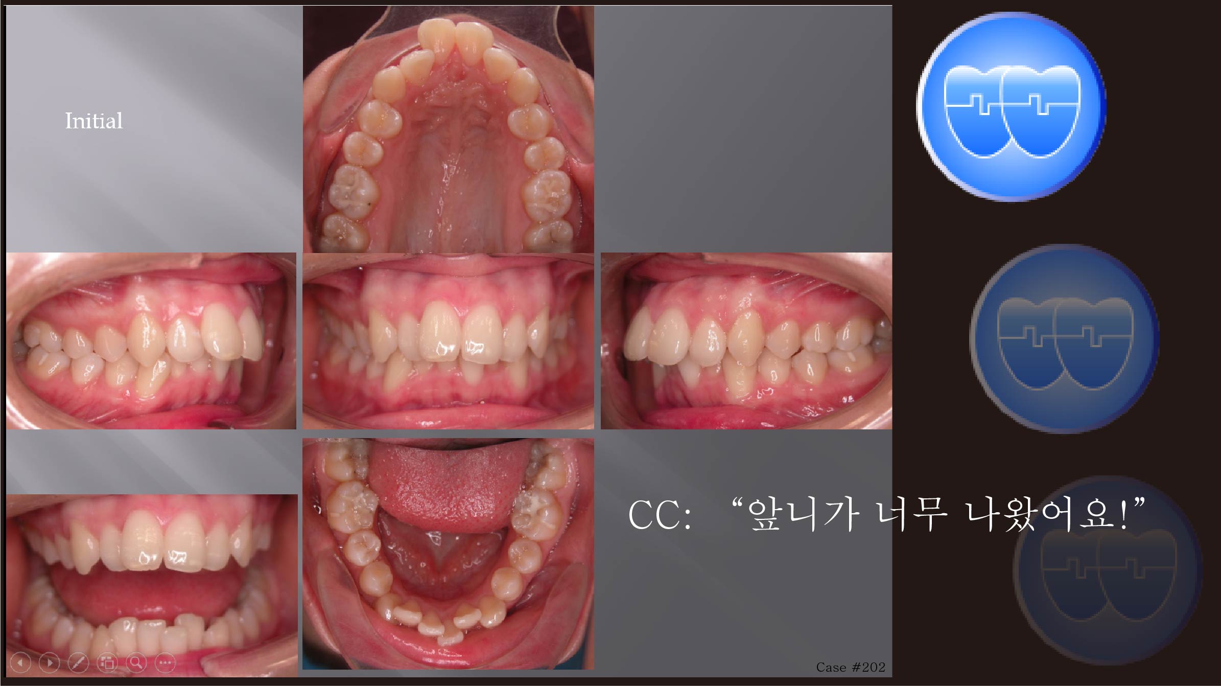 교정 Case 202.  U4L5 발치, Upper Molar Anchorage Control 실패, Upper Corticotomy, 재교정, Sem #13.7