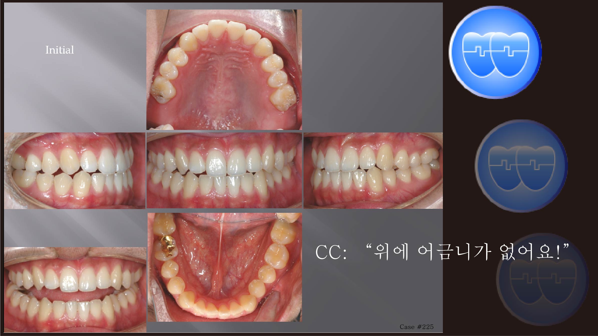 교정 Case 225.  Impacted Upper 7번, 부분교정, Sem #14