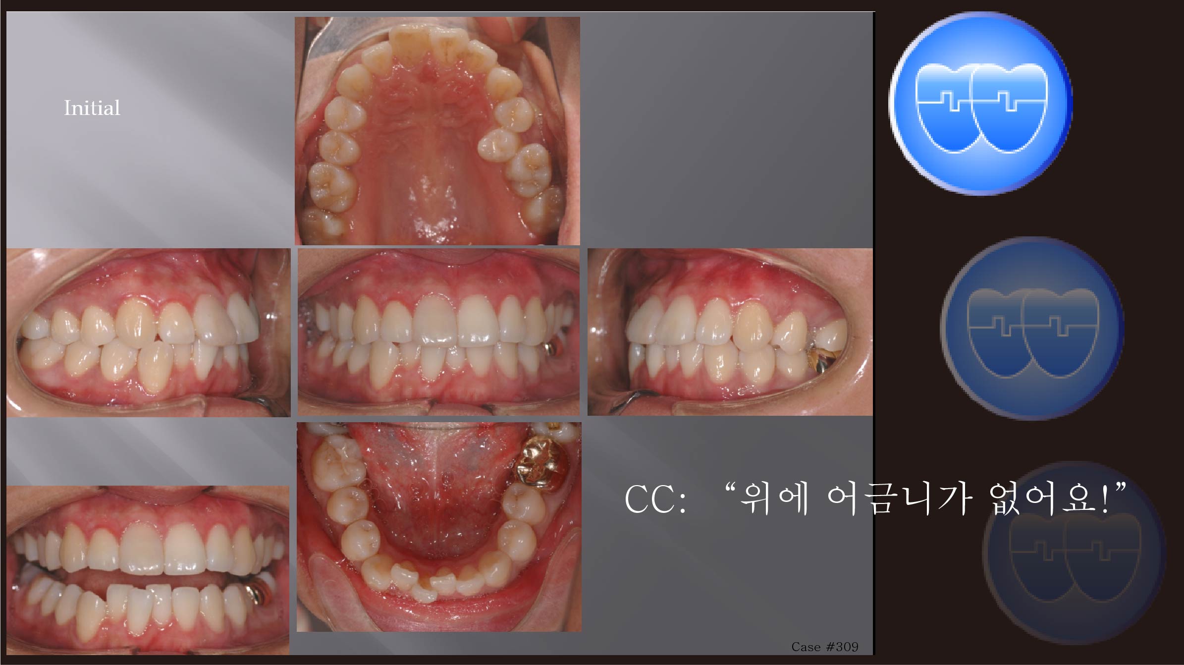 교정 Case 309.  U4L4 발치, Protrusion, Damon Brackets, Skeletal Cl III, Sem #12.1