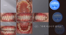 교정 Case 309.  U4L4 발치, Protrusion, Damon Brackets, Skeletal Cl III, Sem #12.1