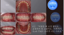 교정 Case 314.  비발치, TMJ Pain, Functional Shift, Bruxer, Sem #19