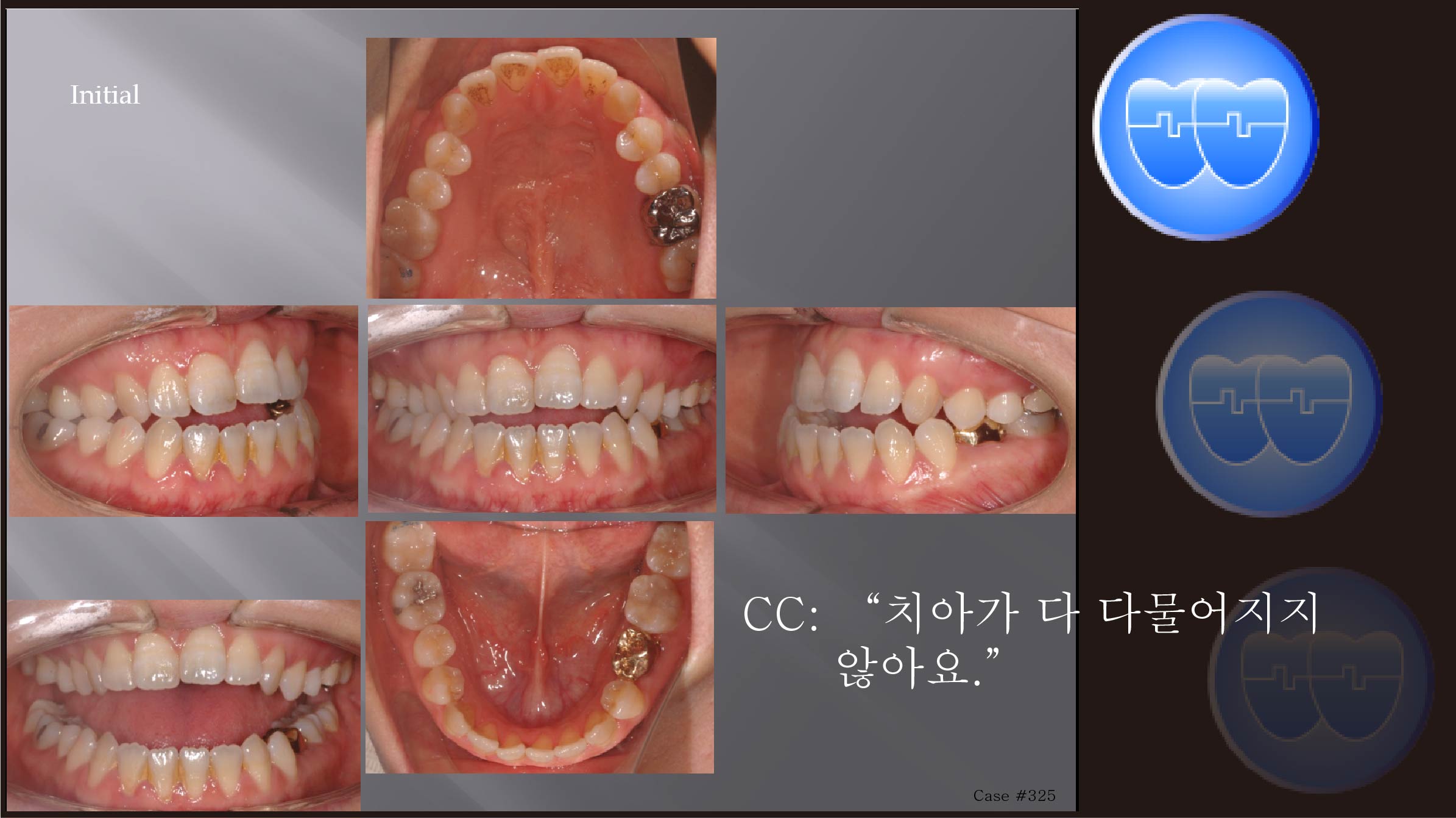 교정 Case 325.  비발치, Class III, Dental Openbite, Posterior Crossbite, Sem #7