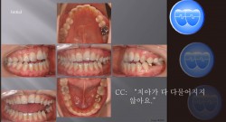 교정 Case 325.  비발치, Class III, Dental Openbite, Posterior Crossbite, Sem #7