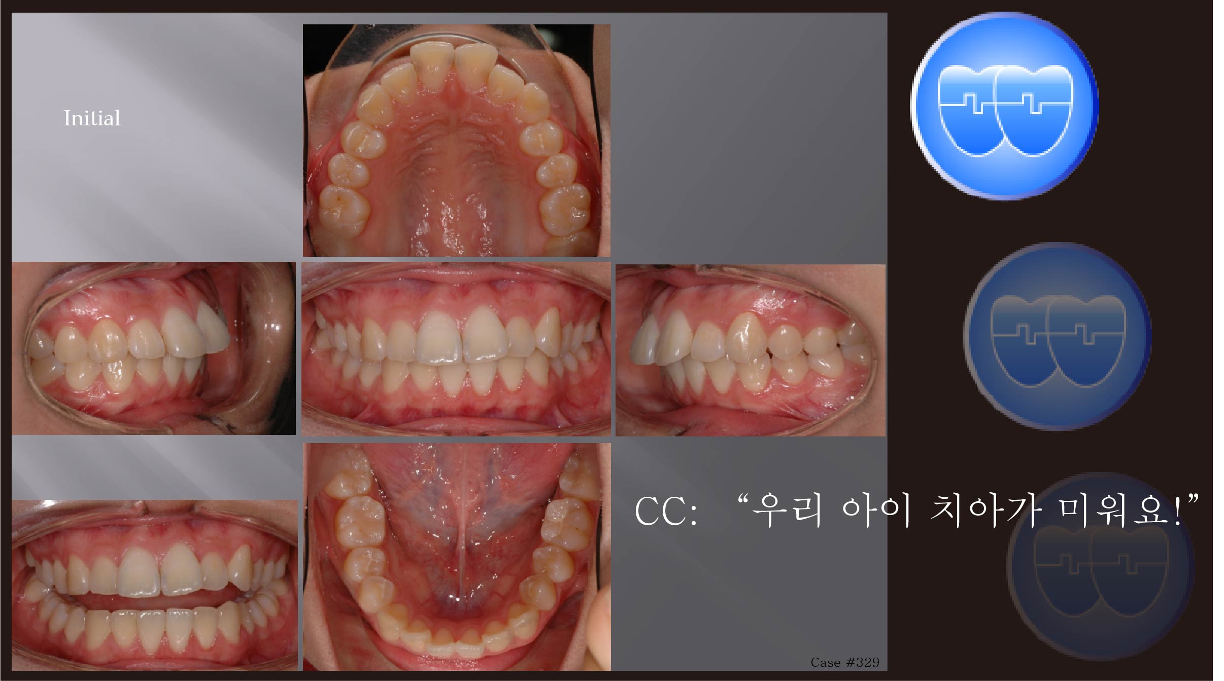 교정 Case 329.  U4L5 발치, Full Class II, Damon Brackets, Sem #10