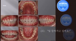 교정 Case 335.  U4L5발치 돌출입, Gingivect, Alveolaopla, Sem #10