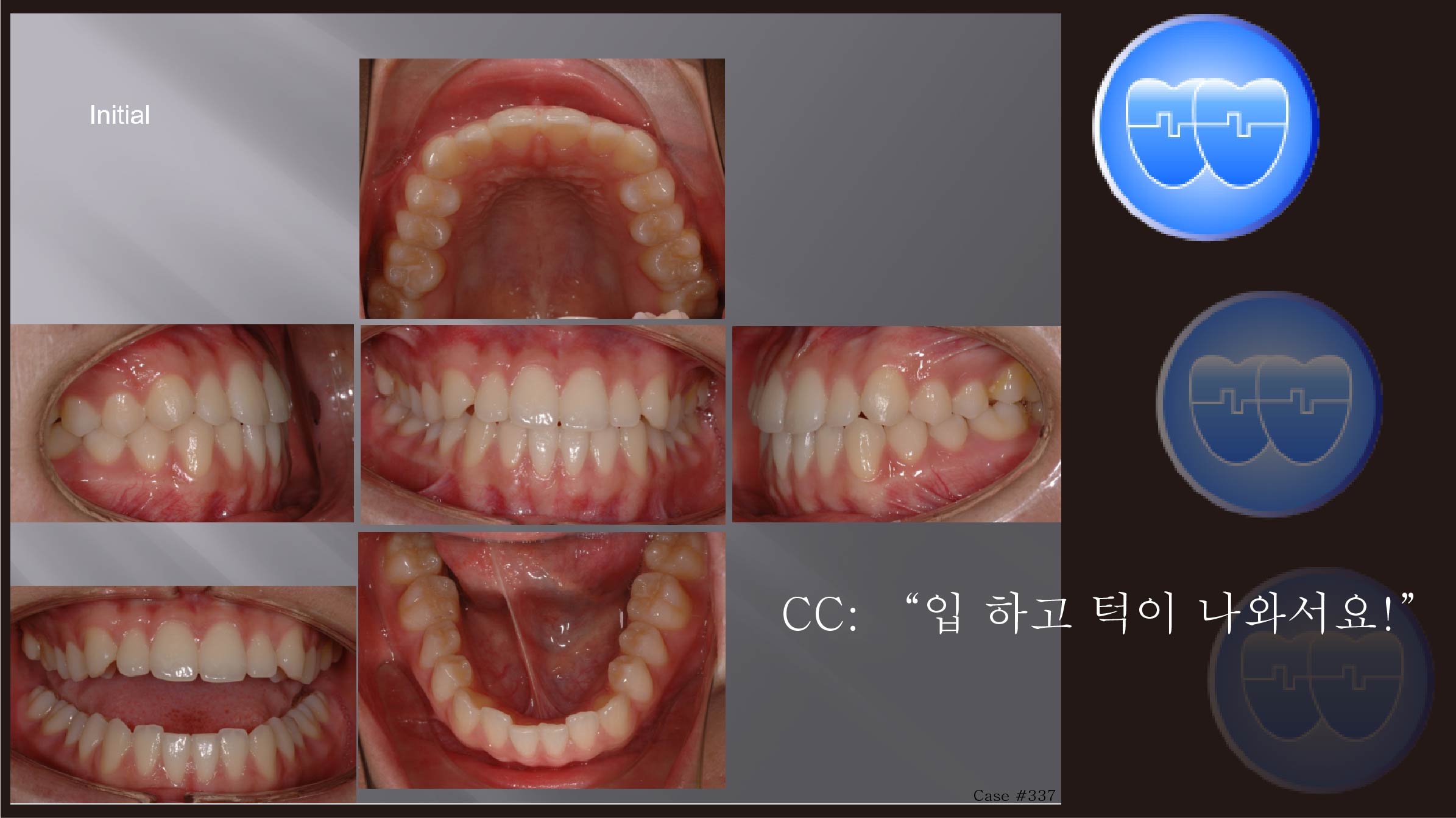 교정 Case 337.  U5L5발치, Class III, Protrusion, Lower Lingual Corticotomy, Sem #12.4