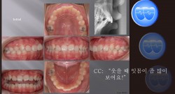 교정 Case 340.  U5 발치, Gummy Smile, Sem #7.5