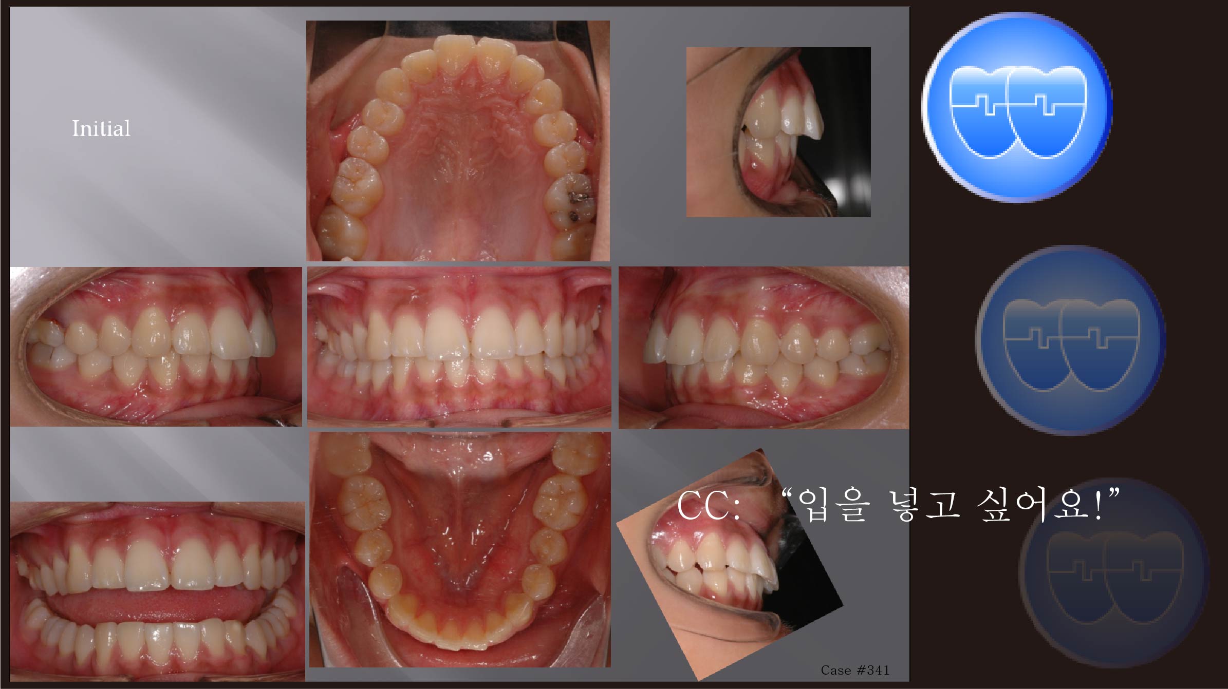 교정 Case 341.  U5 발치,  Miniscrew로 Retraction, Sem #12.6