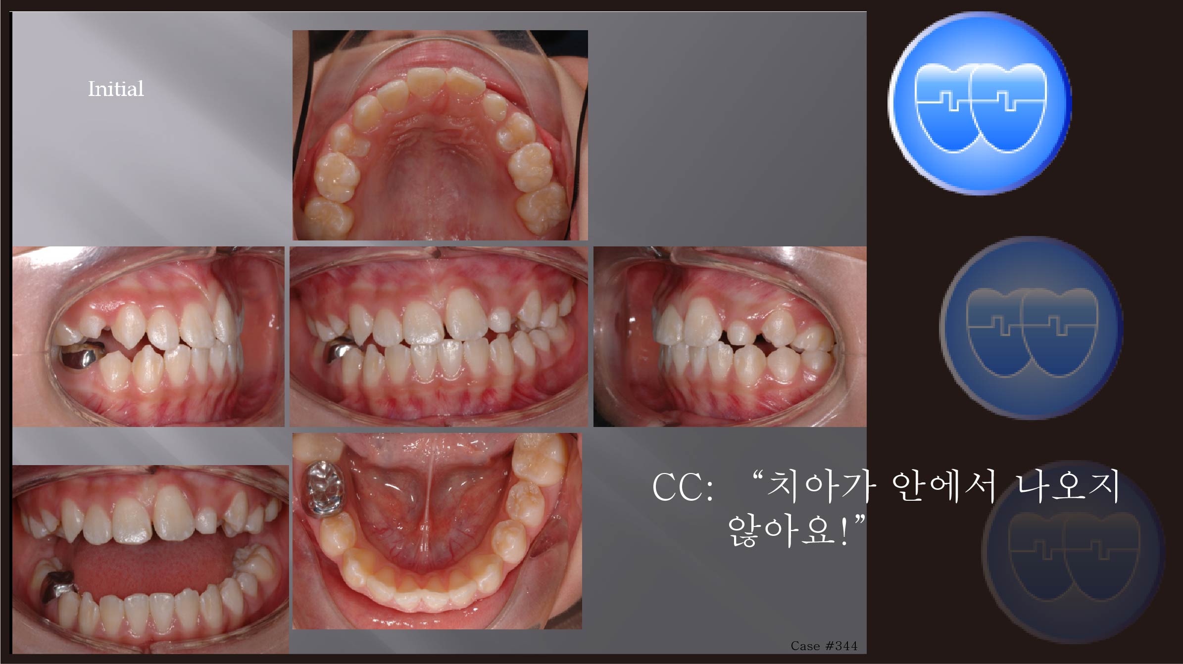 교정 Case 344.  비대칭발치(#15,#22,#35,#45), Malformed #22, Impacted #23, Sem#14