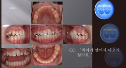 교정 Case 344.  비대칭발치(#15,#22,#35,#45), Malformed #22, Impacted #23, Sem#14