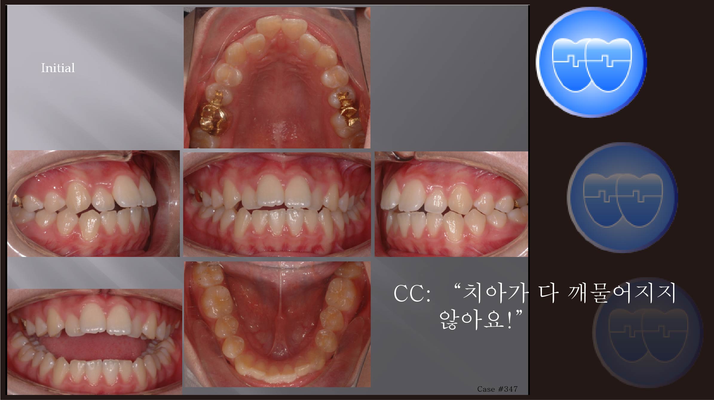 교정 Case 347.  U5 발치, Openbite, Lower Stripping, Sem #12.6