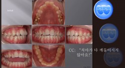 교정 Case 347.  U5 발치, Openbite, Lower Stripping, Sem #12.6