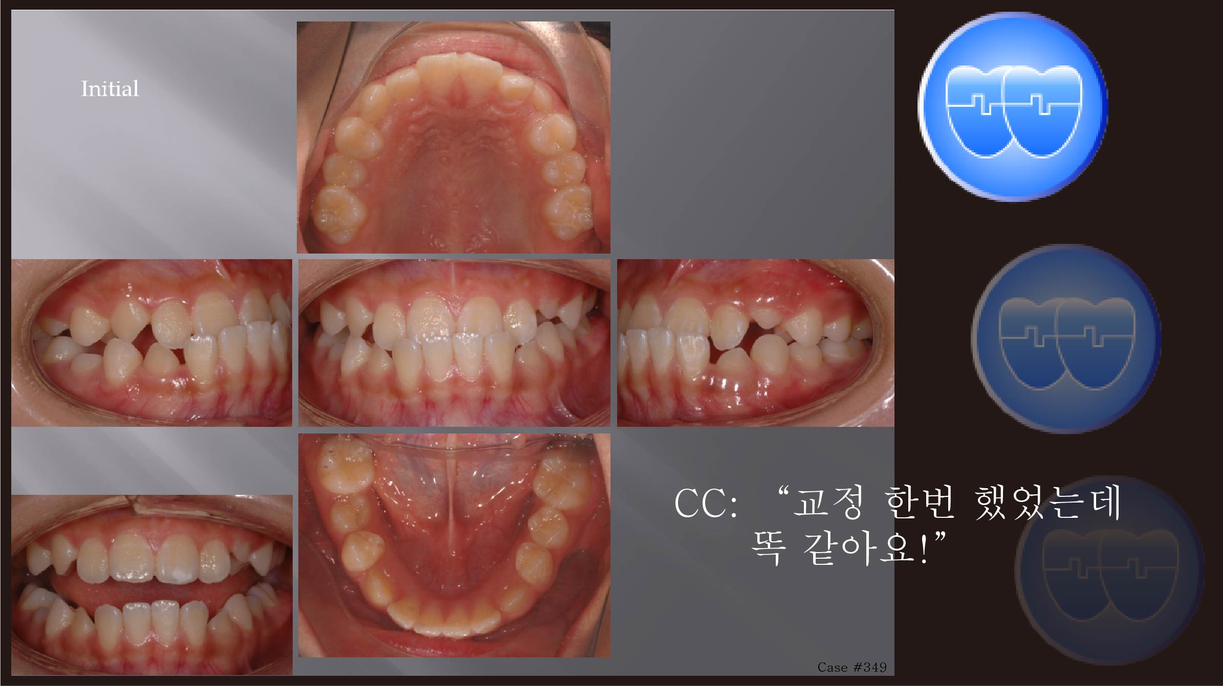 교정 Case 349.  비발치, Class III, Anterior Crossbite, 재교정시작, Sem #6