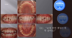 교정 Case 349.  비발치, Class III, Anterior Crossbite, 재교정시작, Sem #6