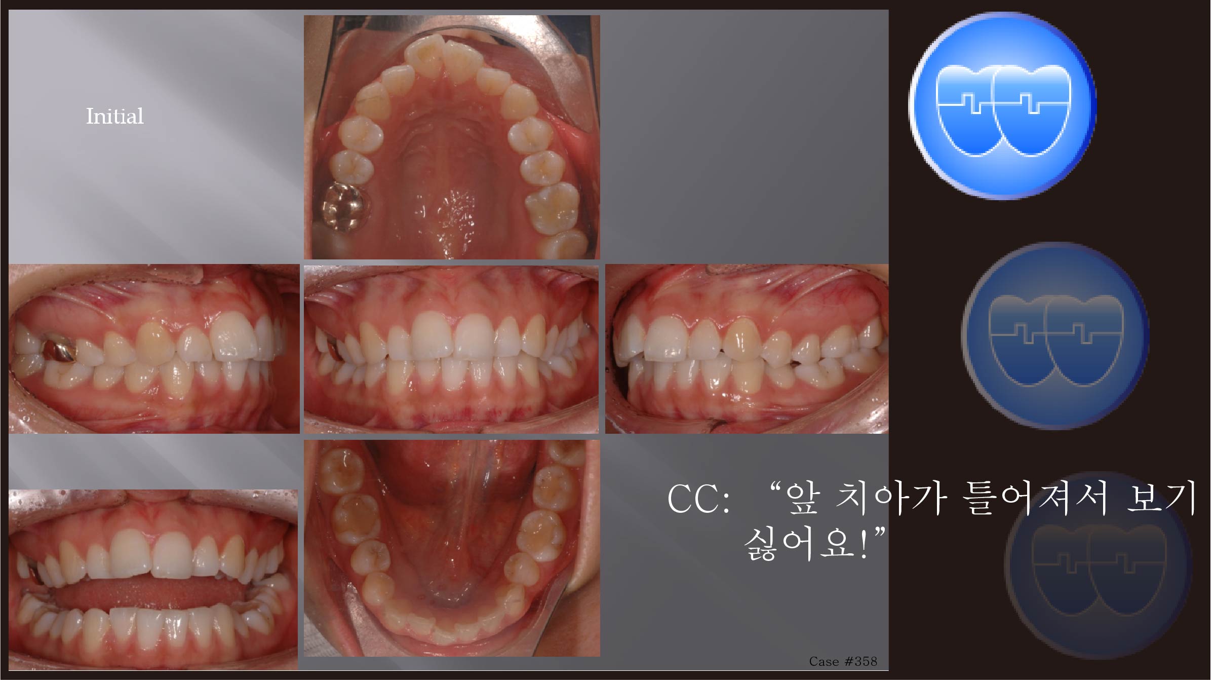 교정 Case 358.  14,24,45 발치, 비대칭 발치, Gummy Smile 가능성, Lower Midline, Sem #6