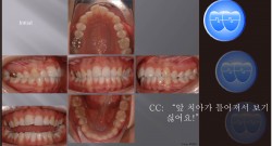 교정 Case 358.  14,24,45 발치, 비대칭 발치, Gummy Smile 가능성, Lower Midline, Sem #6