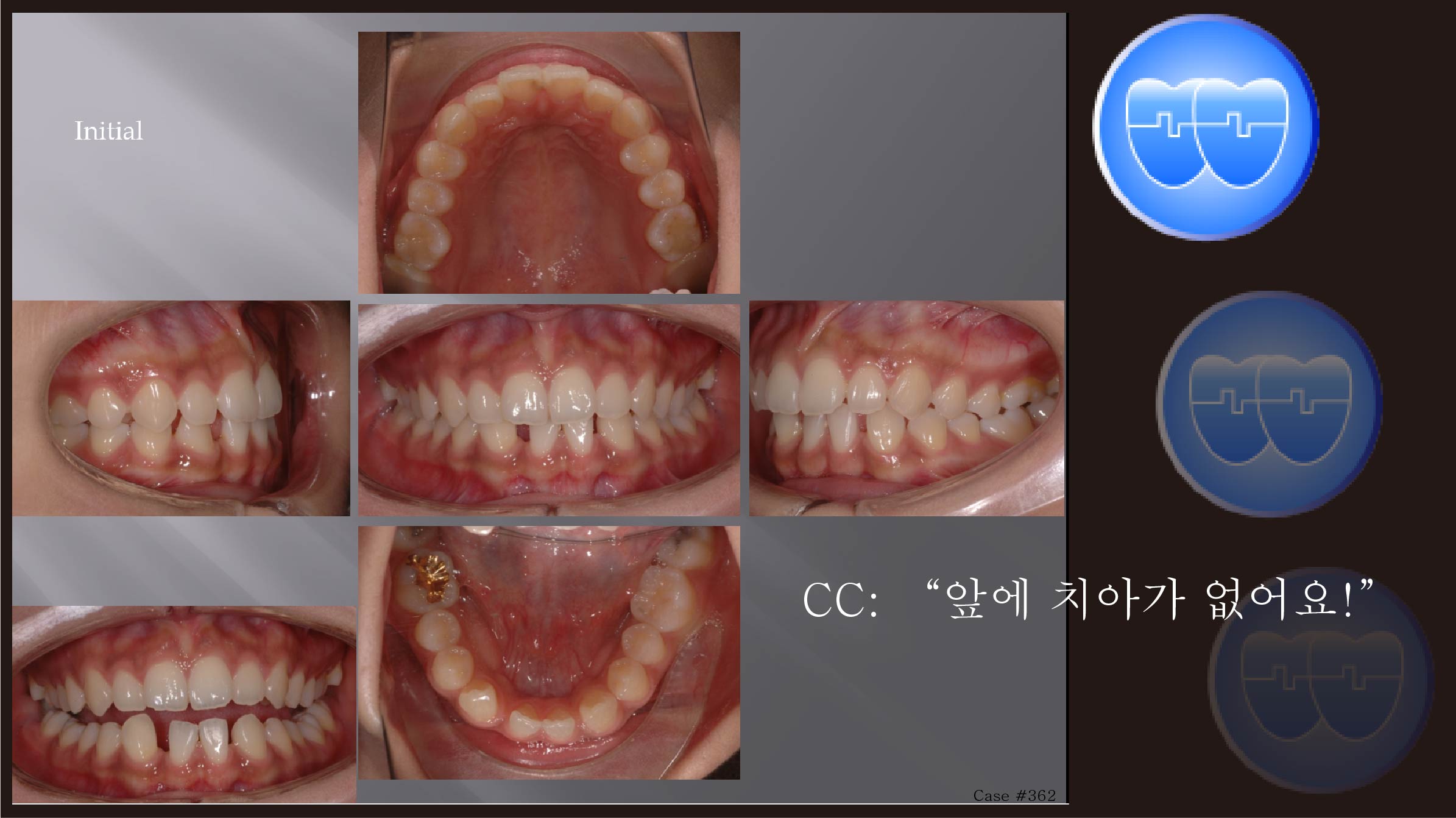 교정 Case 362.  부분교정, Implant, Rotation of #43, Sem #5