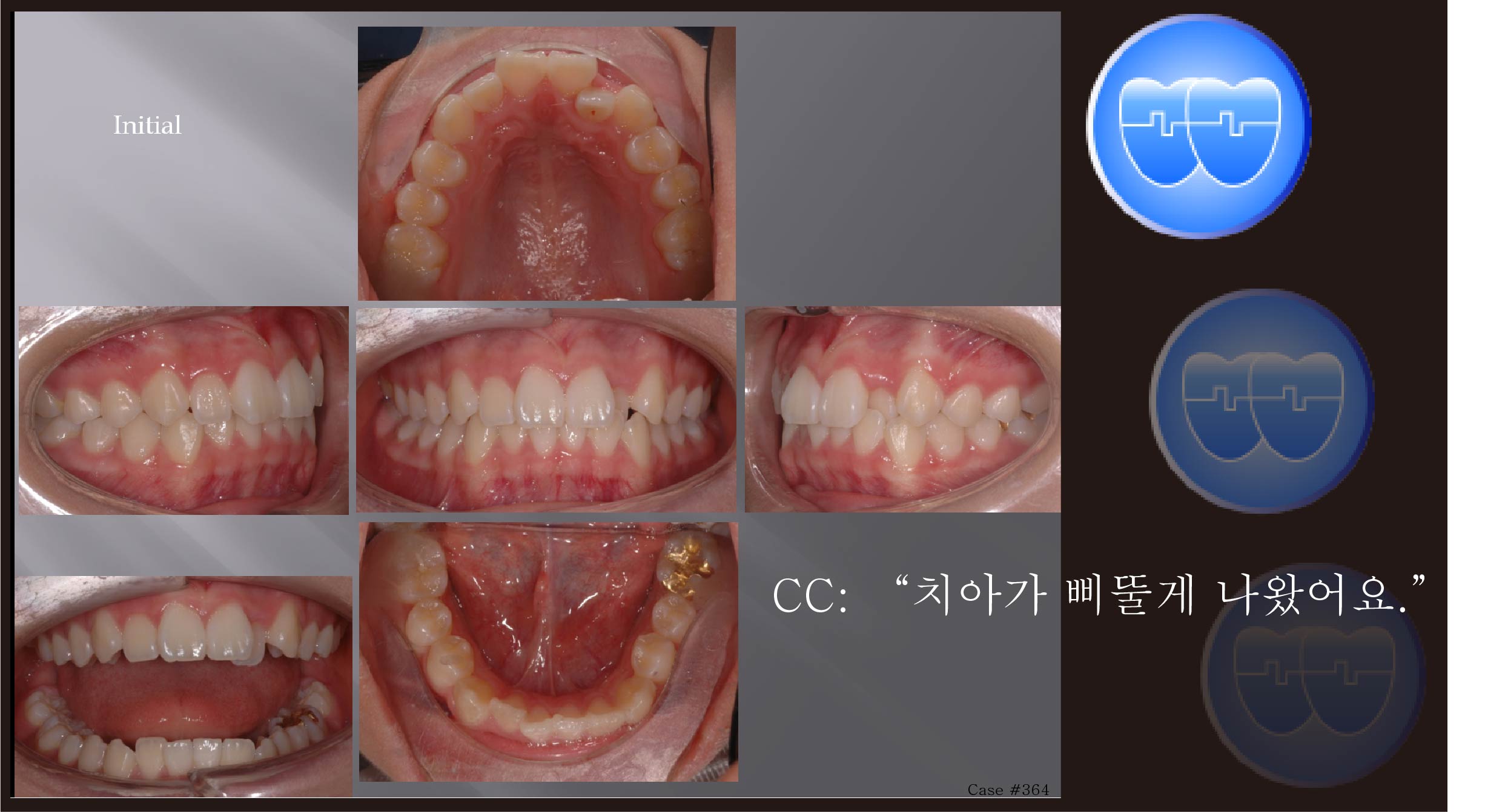 교정 Case 364.  비발치, #22 Crossbite, Root parallelism, Sem #2