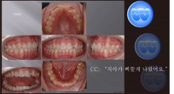 교정 Case 364.  비발치, #22 Crossbite, Root parallelism, Sem #2