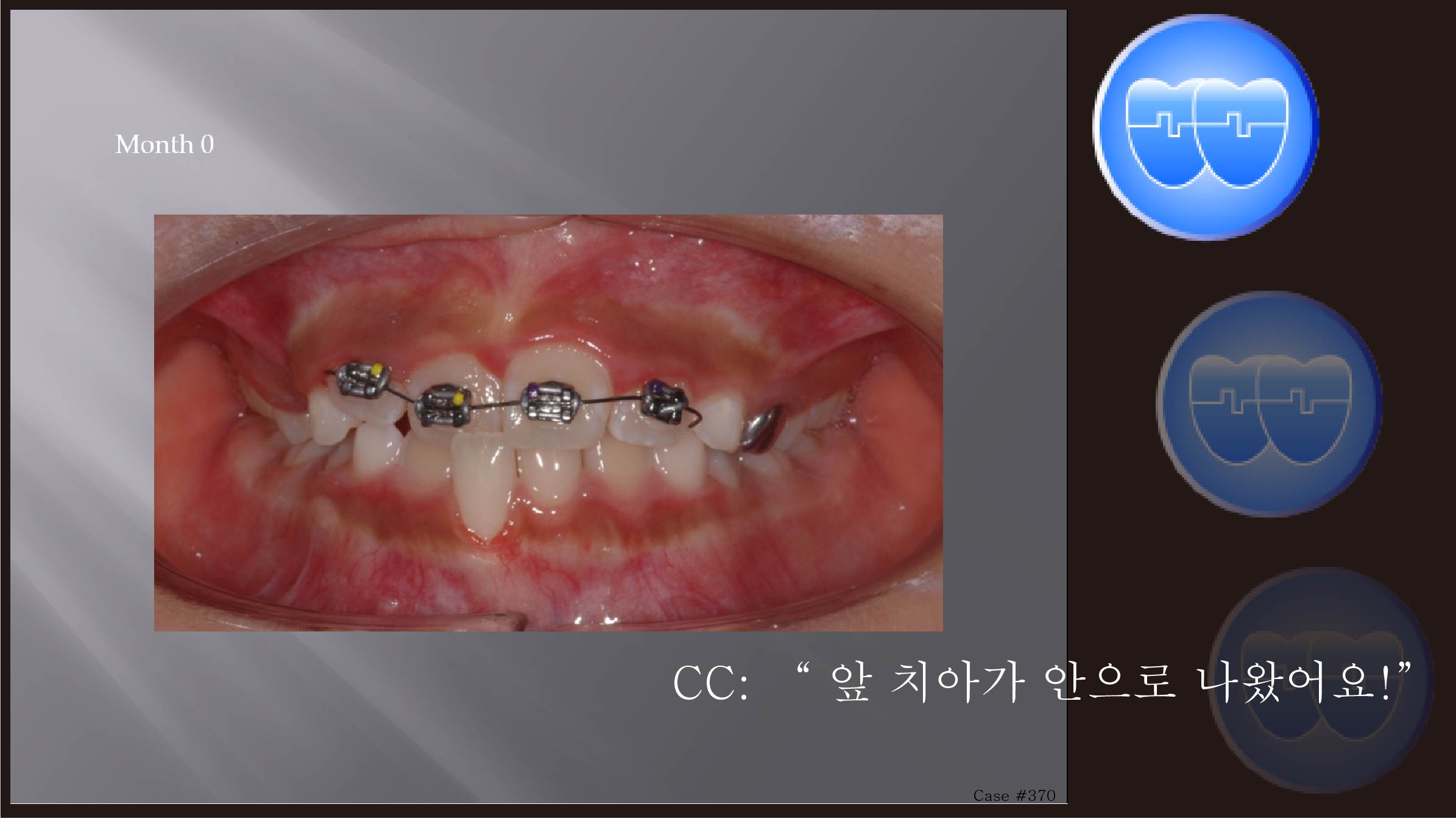 교정 Case 370.  1차 교정, Anterior Crossbite  Recessed Gum Healing, Sem #9