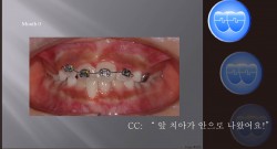 교정 Case 370.  1차 교정, Anterior Crossbite  Recessed Gum Healing, Sem #9