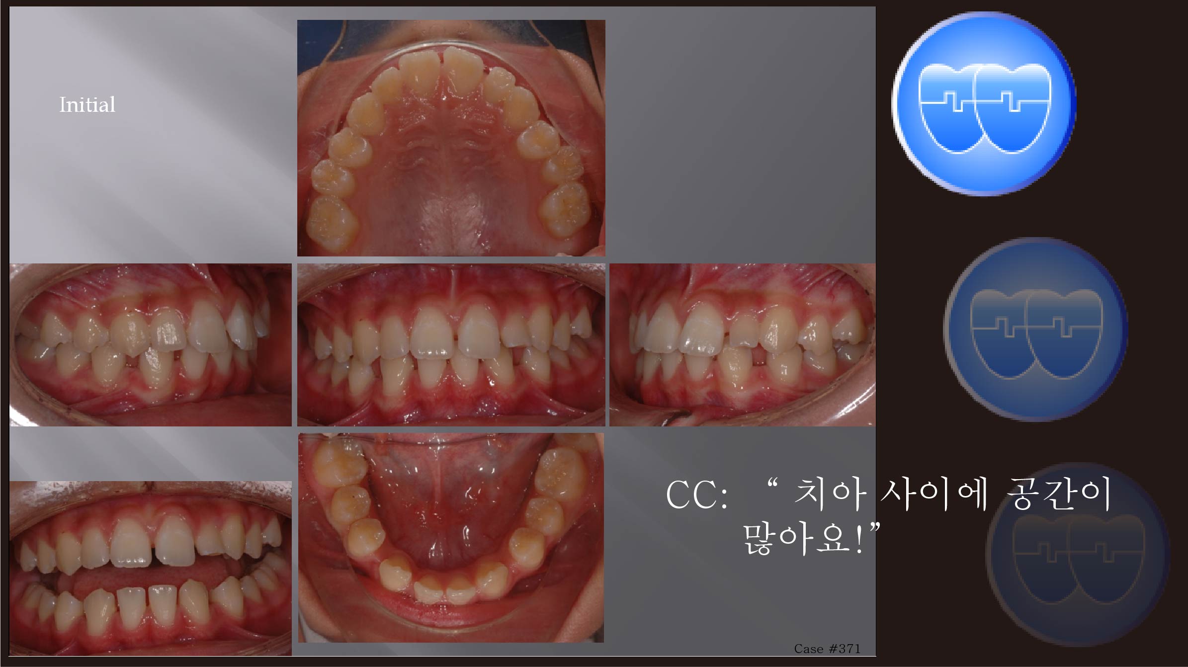 교정 Case 371.  Congenital Missing Two Lower Incisors, Sem #11