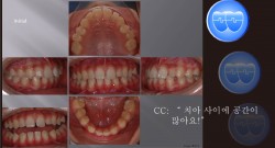 교정 Case 371.  Congenital Missing Two Lower Incisors, Sem #11