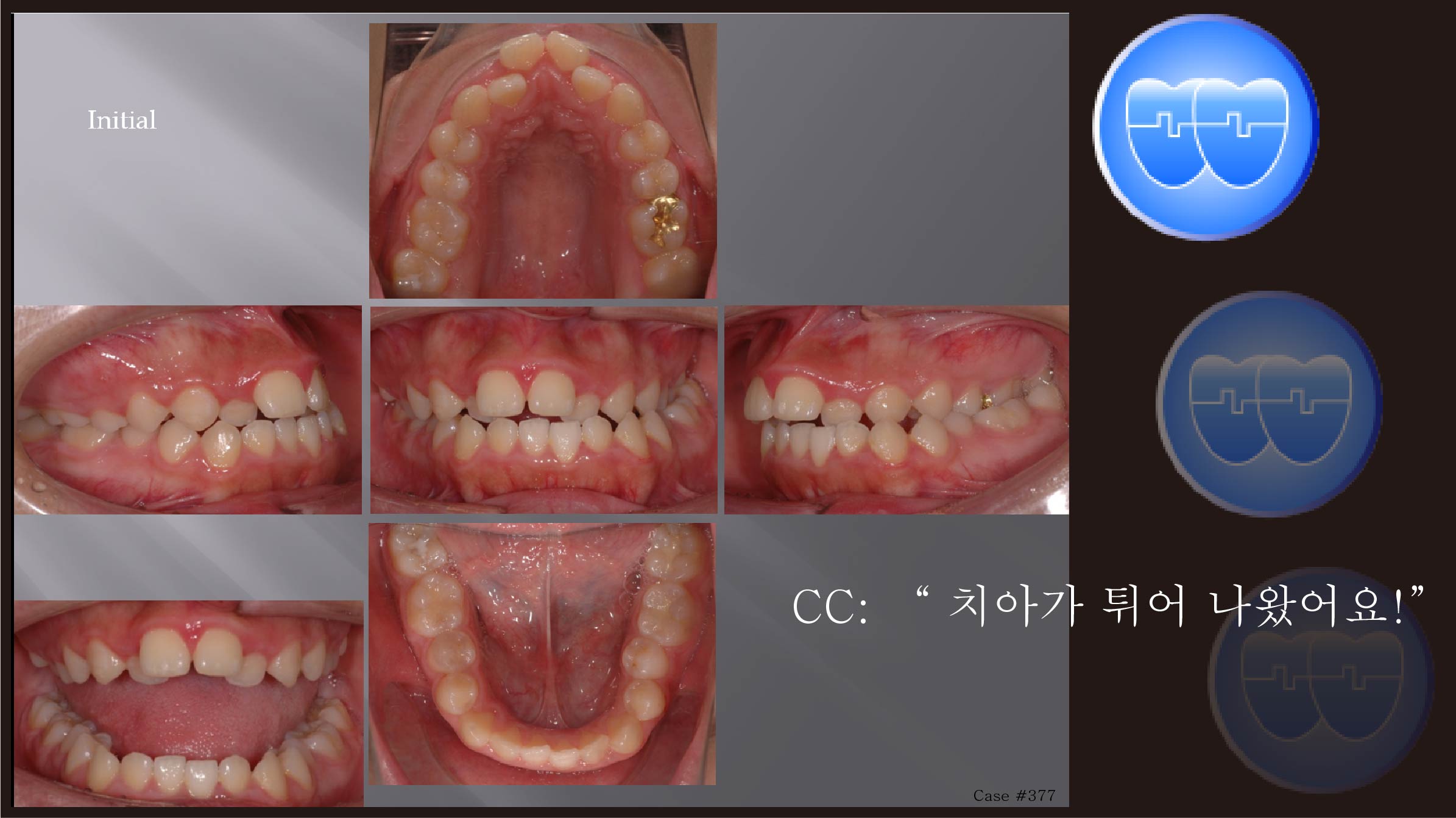 교정 Case 377.  비발치, Gummy Smile, Proclined Upper Incisors, Functional Shift, Posterior Crossbite, Sem #7.5