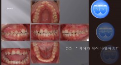 교정 Case 377.  비발치, Gummy Smile, Proclined Upper Incisors, Functional Shift, Posterior Crossbite, Sem #7.5