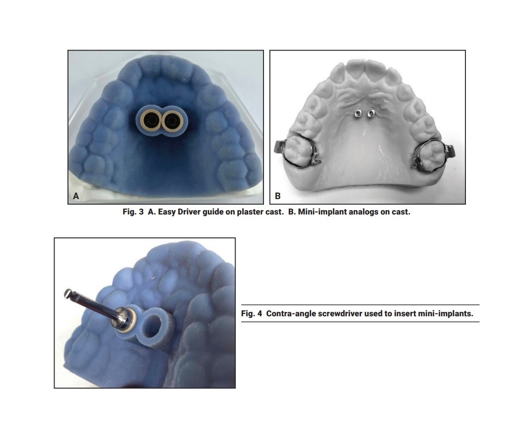 The Easy Driver for Placement of Palatal Mini-implants and a Max Expander