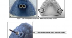 The Easy Driver for Placement of Palatal Mini-implants and a Max Expander