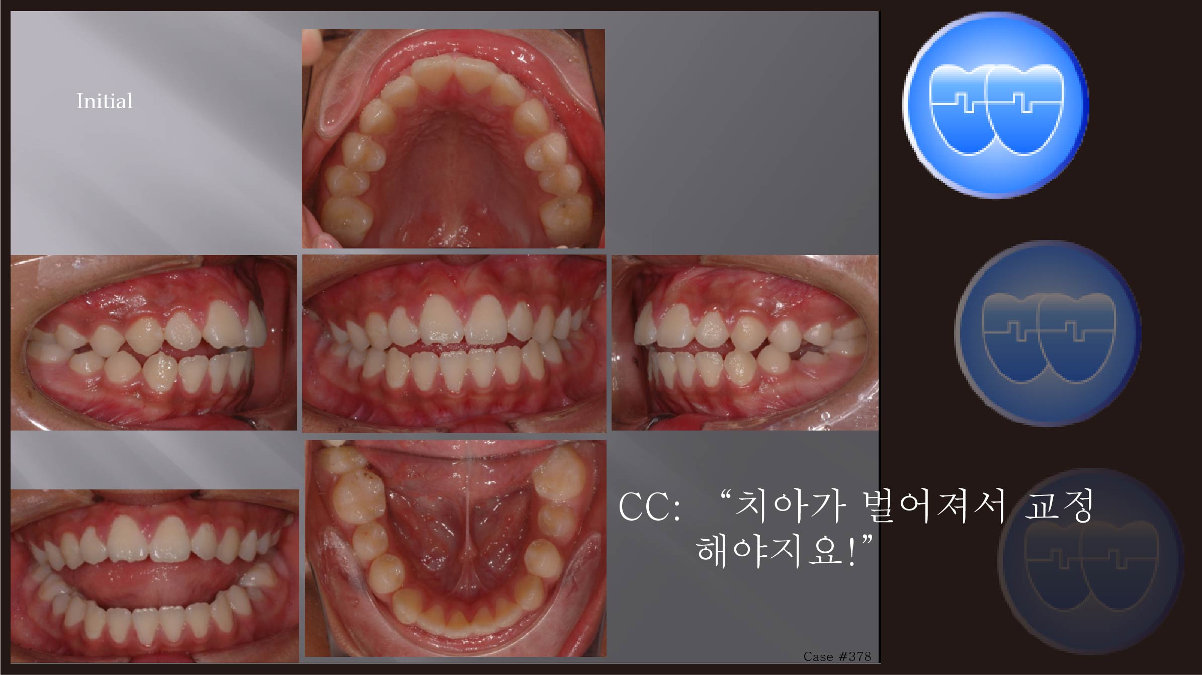 교정 Case 378.  U4L5 발치, Dental Openbite, Perio Problem, Sem #7