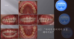 교정 Case 378.  U4L5 발치, Dental Openbite, Perio Problem, Sem #7