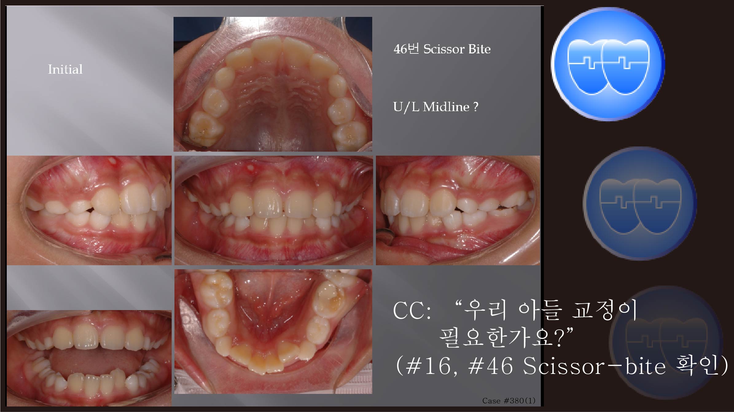 교정 Case 380(1).  1차 교정, Lower Crowding, Scissor Bite, Sem #9