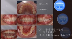 교정 Case 380(1).  1차 교정, Lower Crowding, Scissor Bite, Sem #9