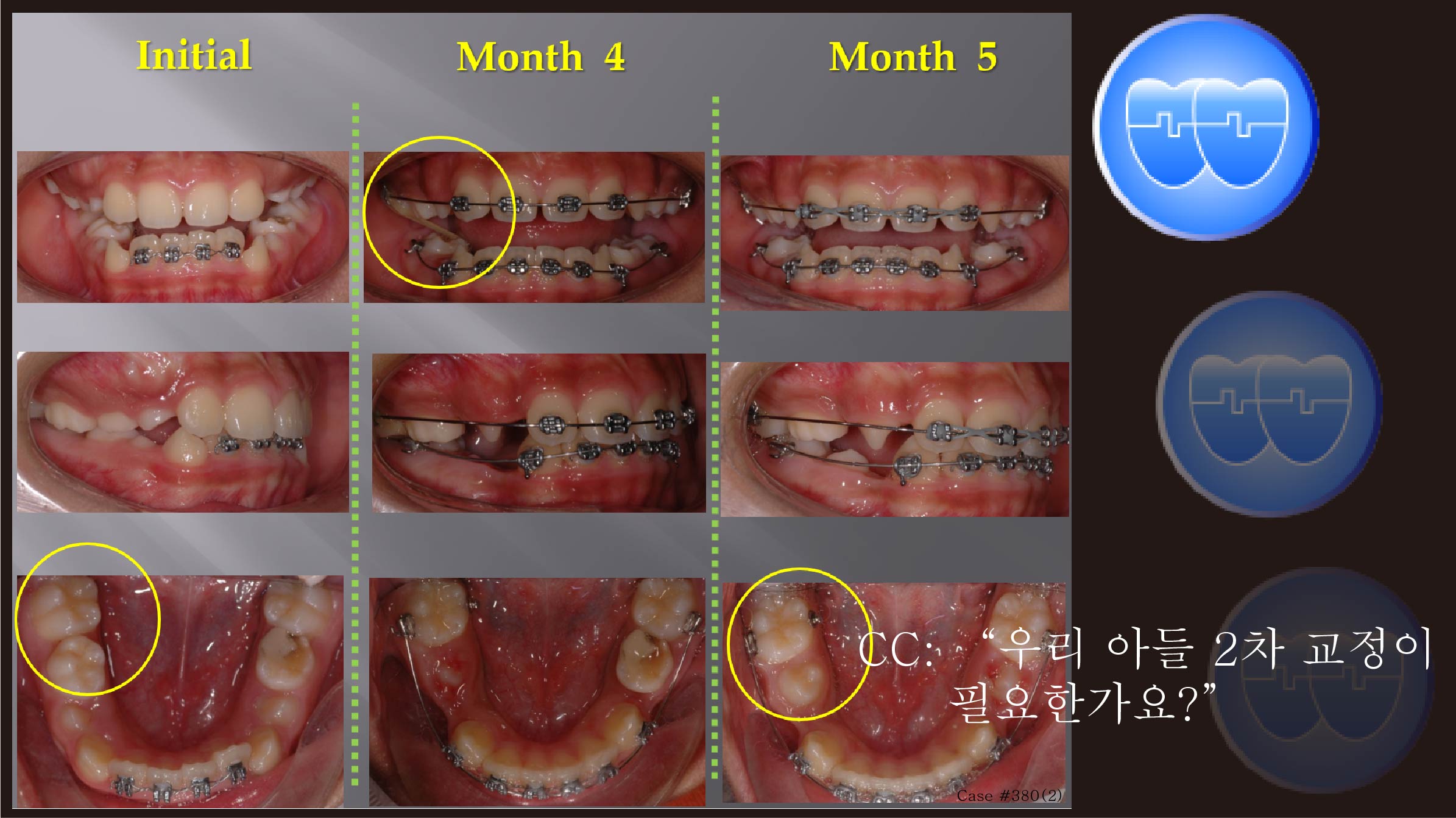 교정 Case 380(2).  U4L4 발치, Posterior Scissor-bite, Sem#12.1