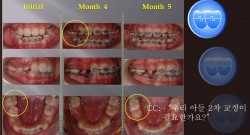 교정 Case 380(2).  U4L4 발치, Posterior Scissor-bite, Sem#12.1