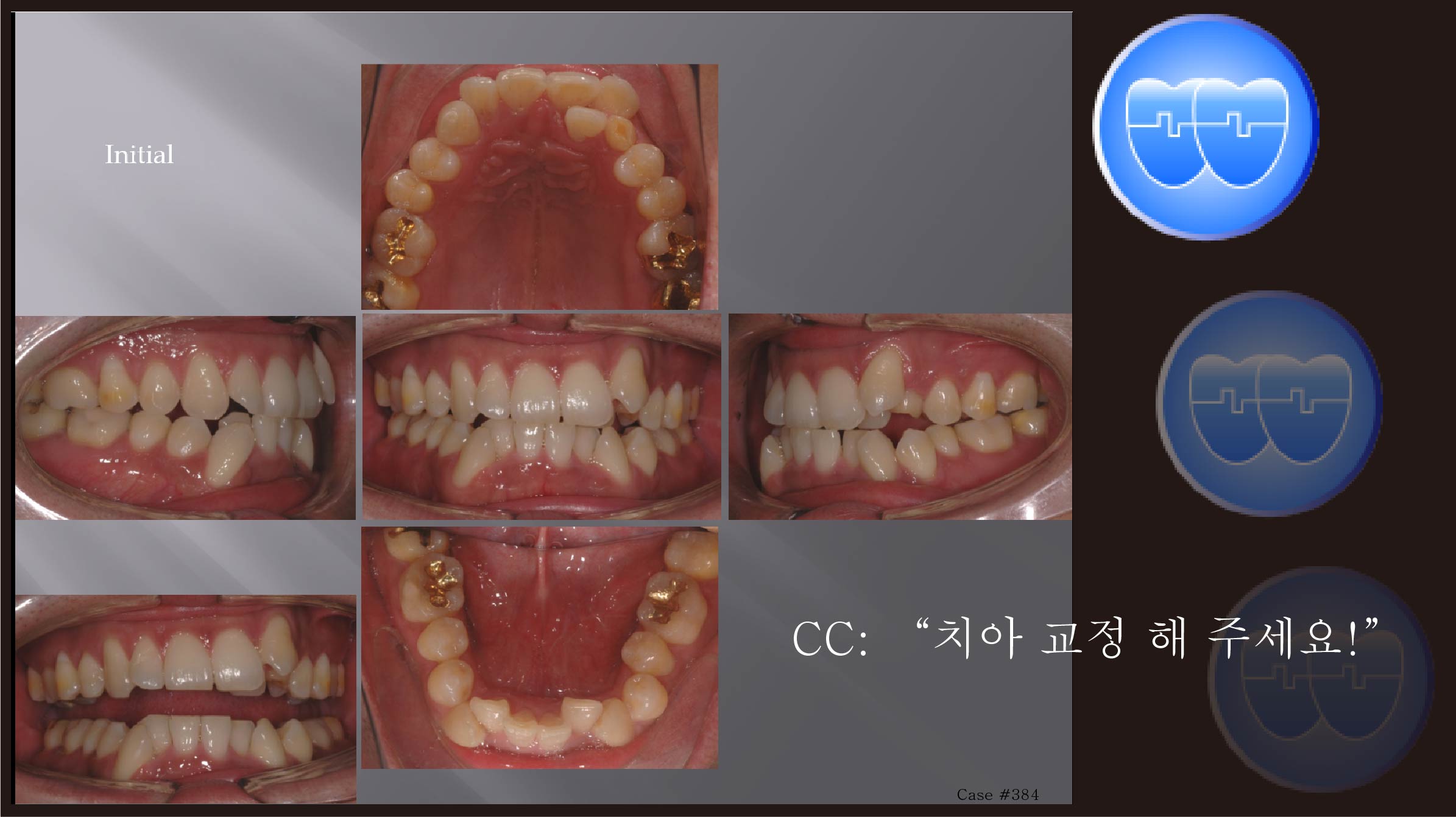 교정 Case 384.  L4 발치, Lower Severe Crowding, Sem #12.7