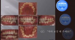 교정 Case 384.  L4 발치, Lower Severe Crowding, Sem #12.7