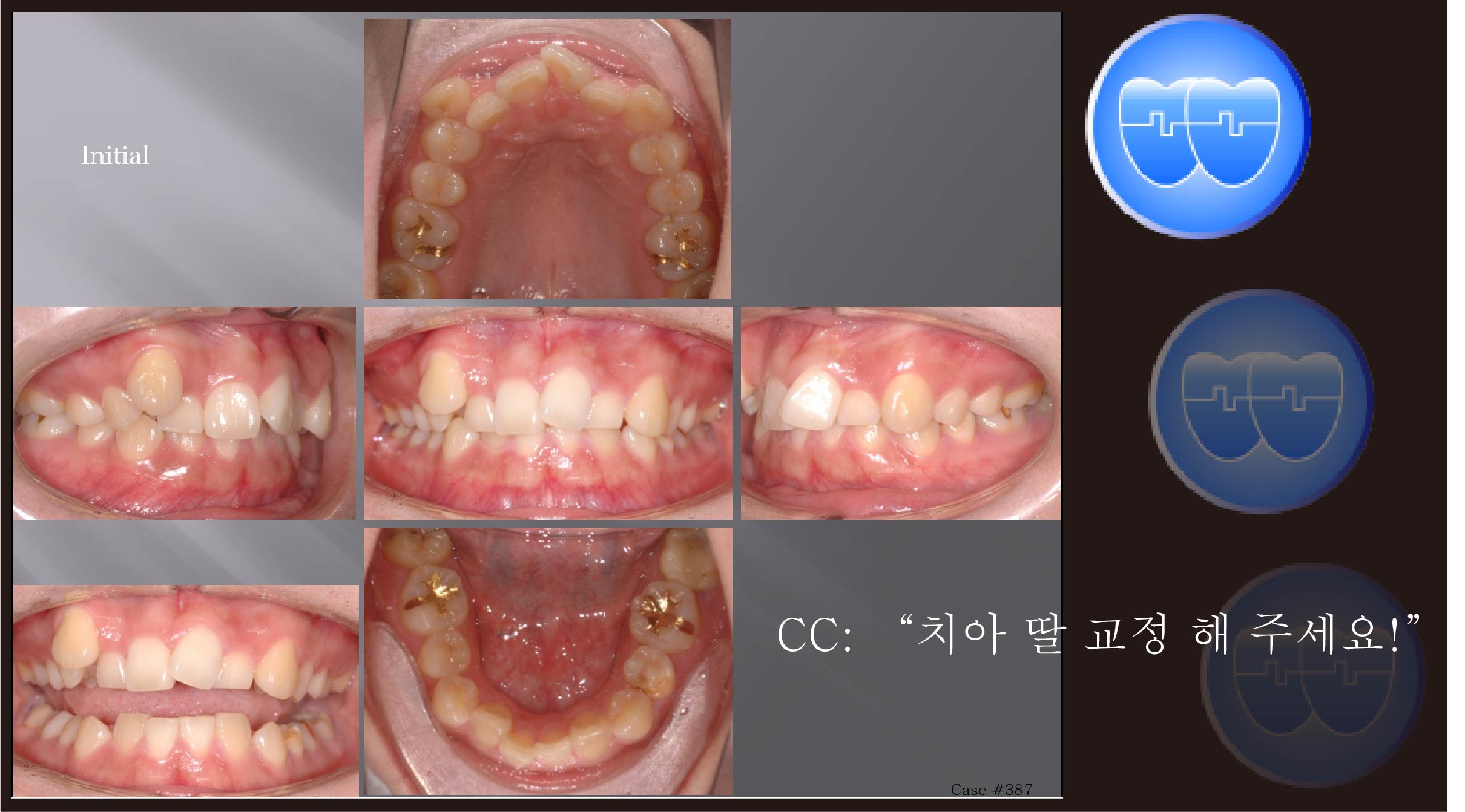 교정 Case 387.  U4 발치, Two Lower Incisors Finish, Congenital Missing, Sem #11