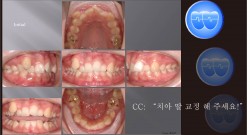 교정 Case 387.  U4 발치, Two Lower Incisors Finish, Congenital Missing, Sem #11