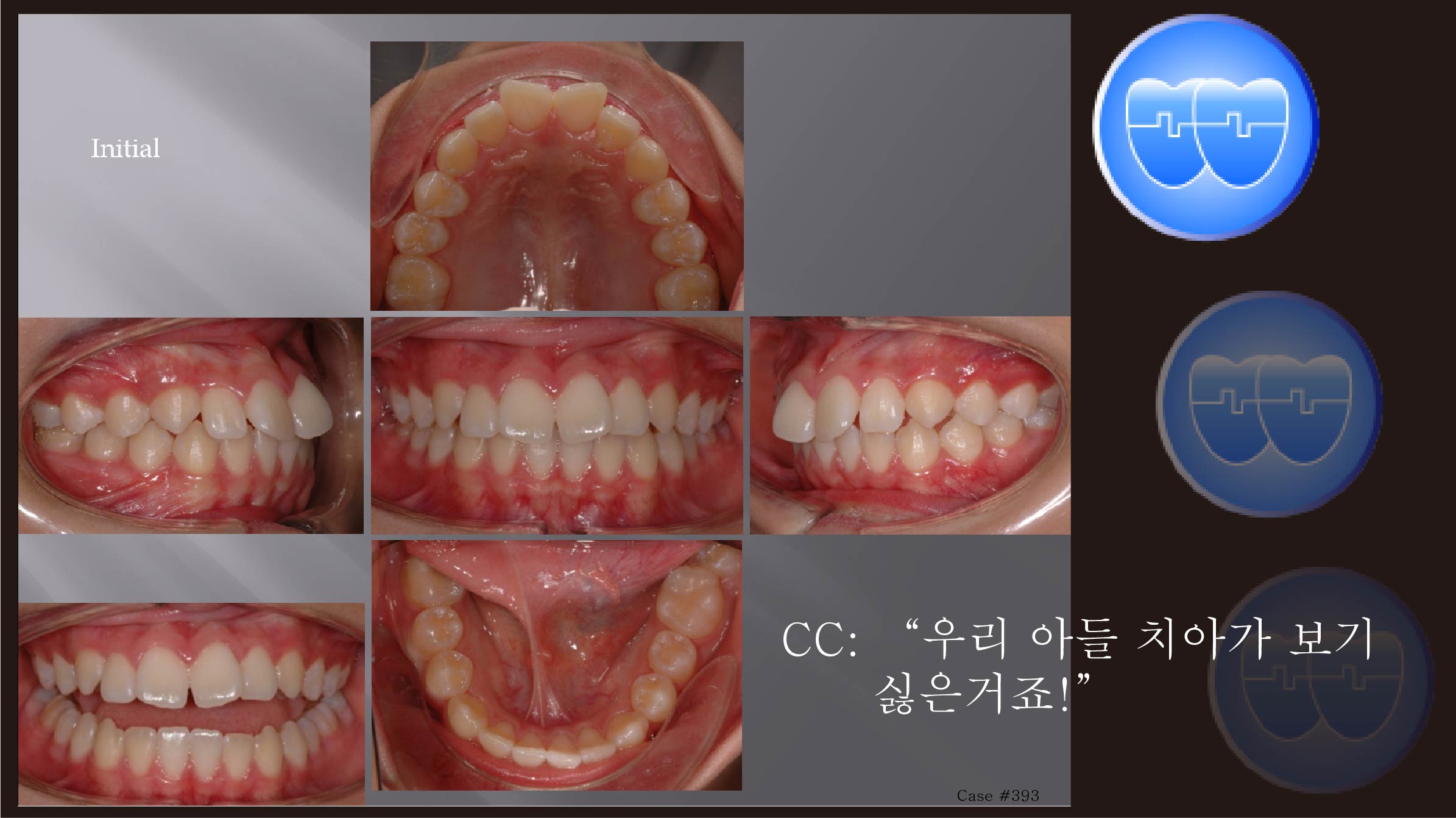 교정 Case 393.  U5 발치,  돌출입, Gummy Smile, Sem #7.5