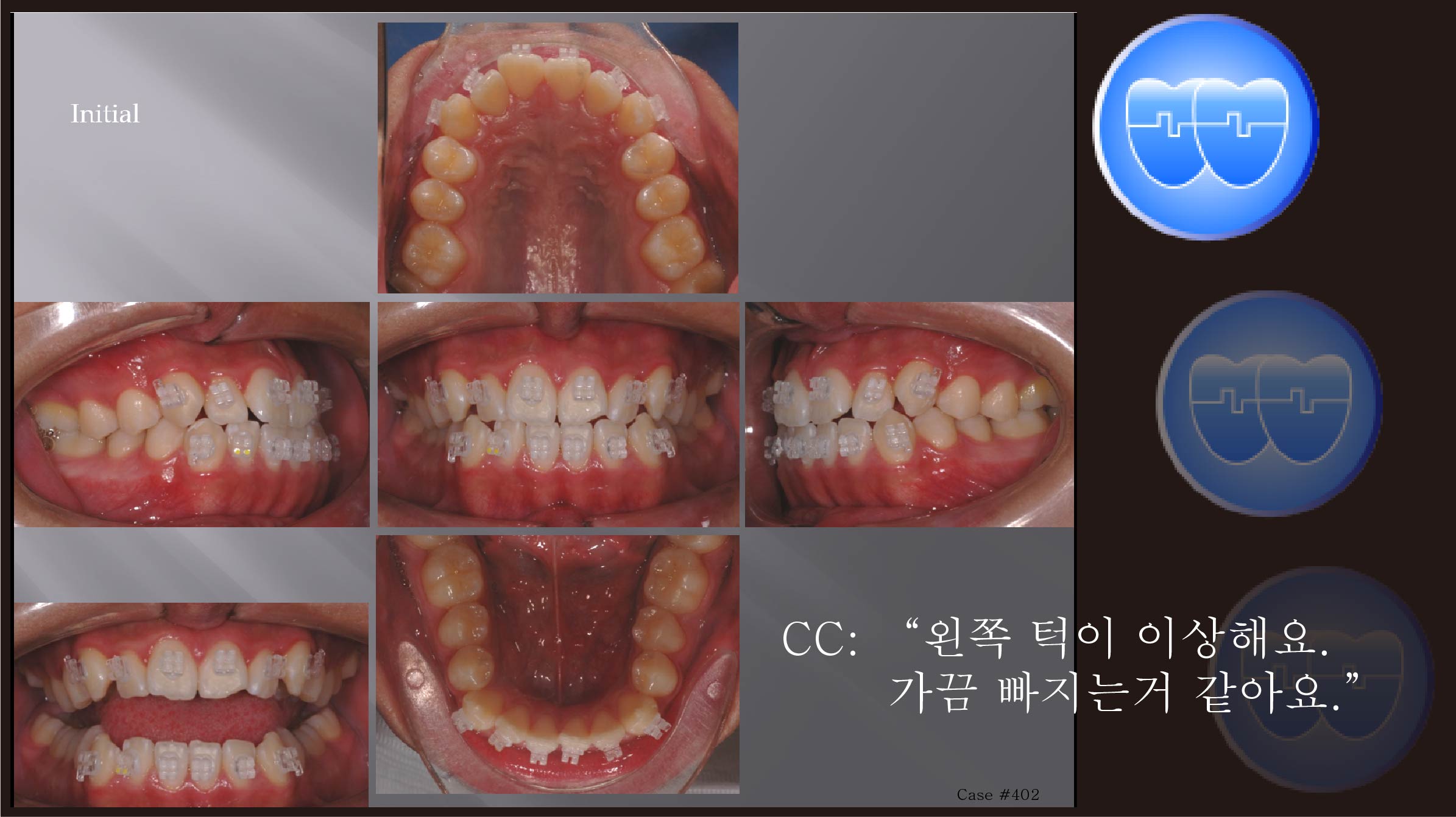 교정 Case 402.  비발치, TMJ 호소, 성장, Relapse, Sem# 19