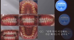 교정 Case 402.  비발치, TMJ 호소, 성장, Relapse, Sem# 19